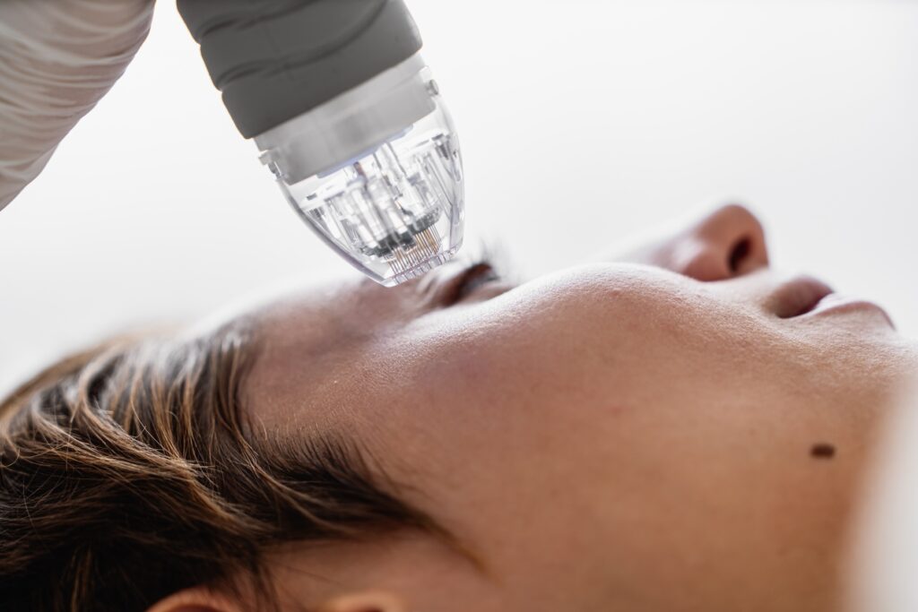Patient relaxing as they begin their microneedling near West Fargo treatment, with the applicator pressing gently to the skin.