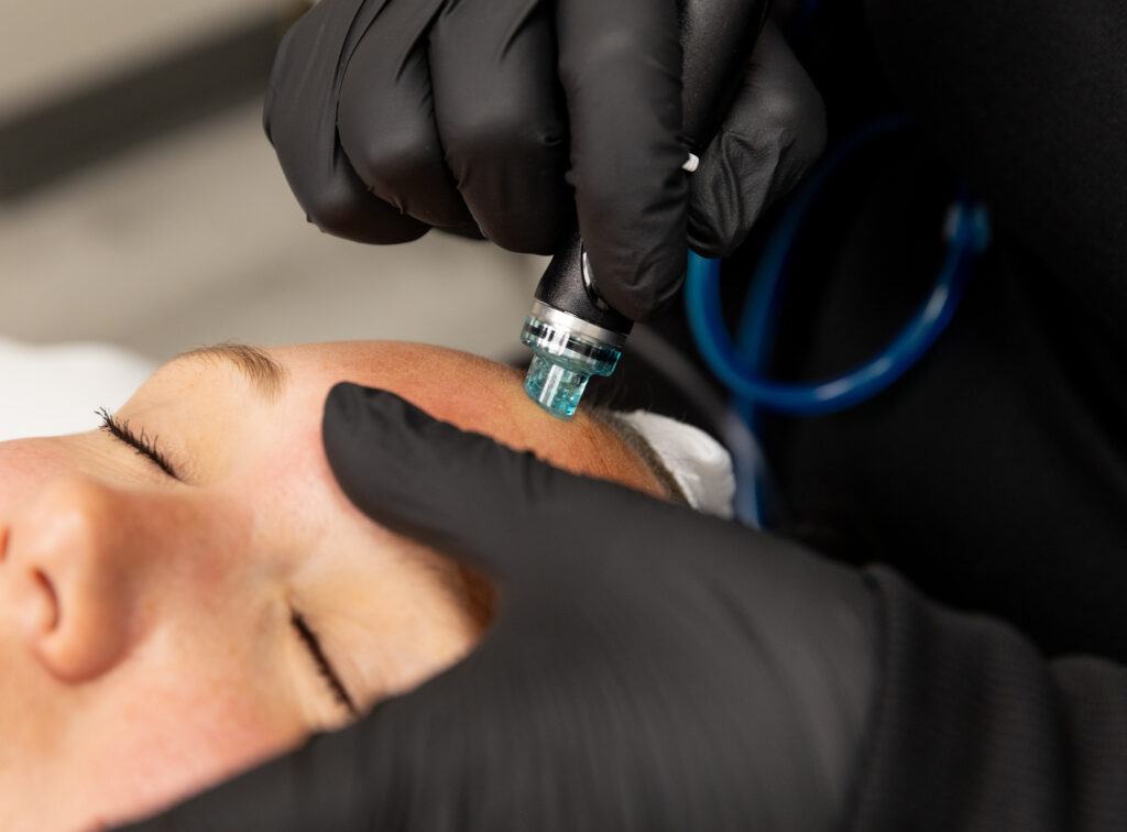 A patient relaxes as they receive their acne treatment near Moorhead, MN. Their provider, wearing surgical gloves, gently guides the HydraFacial wand over the patient's forehead, helping to fully cleanse and hydrate the area.