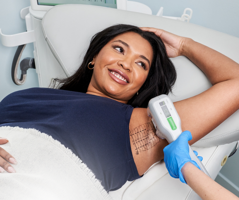  A patient relaxes on a treatment bed, smiling, as she receives her excessive sweat treatment in Fargo. Her provider is holding the hand-held treatment tool used during MiraDry treatments to the skin of her armpit.